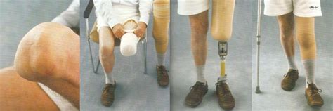 Knee Disarticulation Prostheses – Matrix Mobility & Assistive Technologies