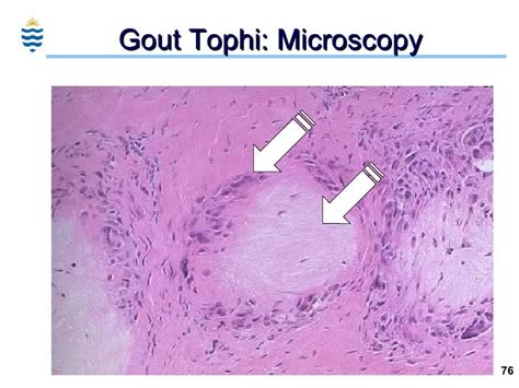 tophi gout - pictures, photos