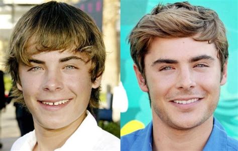 Zac Efron before and after plastic surgery (19) | Celebrity plastic surgery online