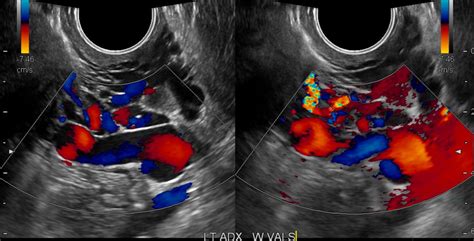 Pelvic Congestion Syndrome: Primary and Secondary Types | Michael ...