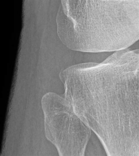 Segond fracture | Radiology Case | Radiopaedia.org