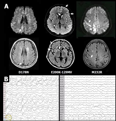 Brain Interactive: 퇴행성 뇌질환 - 2. CJD(Creutzfeldt-Jakob Disease)’s Diagnosis