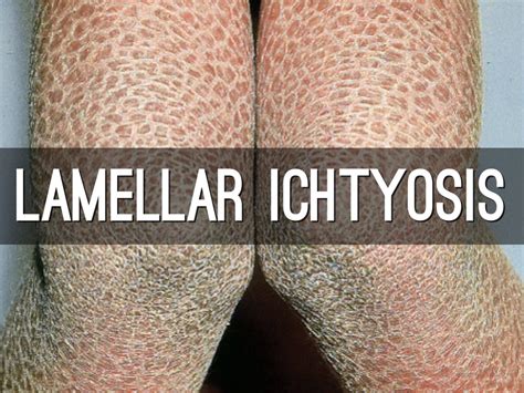 Lamellar Ichtyosis by Milk 2%