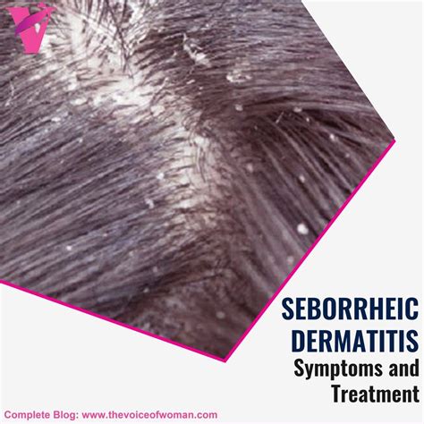 Seborrheic Dermatitis is a skin #disease that causes itchy rashes and the scalp becomes flaky ...