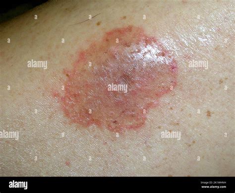 Pigmented purpuric dermatosis Stock Photo - Alamy