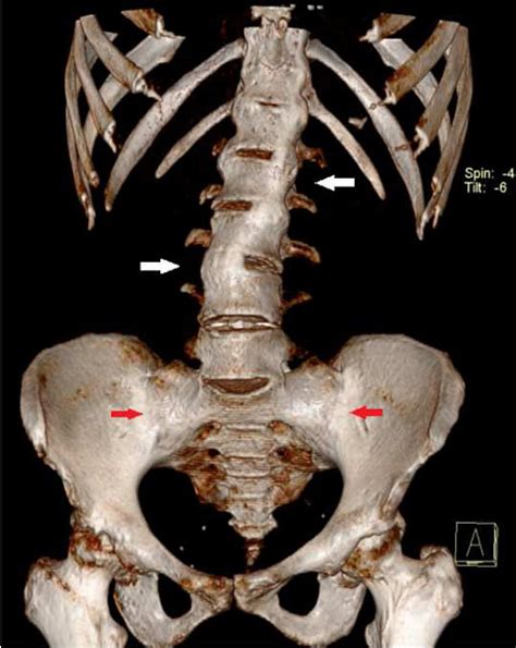 Bamboo spine: Ankylosing spondylitis - International Journal of Case Reports and Images (IJCRI)