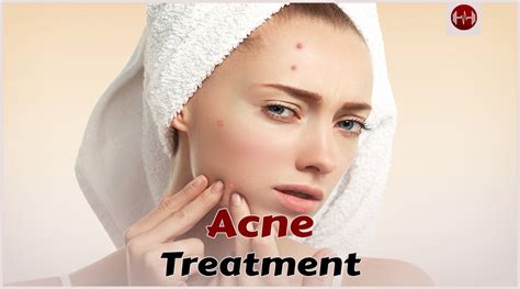 Effective Acne Treatments: Your Ultimate Guide to Clear Skin - aestheticbeats