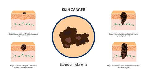 Melanoma Stages Poster Stock Illustration - Download Image Now ...