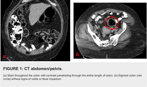 [PDF] Rare Presentation of Stercoral Ulcer Spontaneous Perforation Without Preceding ...