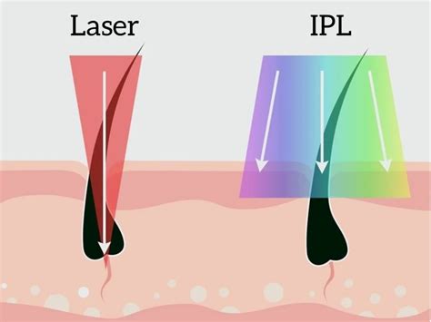 IPL vs Laser Hair Removal - Setsuko Beauty Clinic