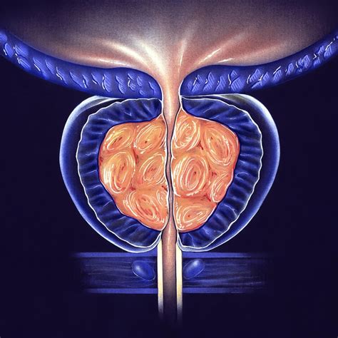 Benign Prostatic Hyperplasia (BPH) | The Urology Group of Virginia