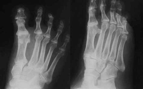 Congruent Lisfranc joint with early degenerative changes on 28-mo ...