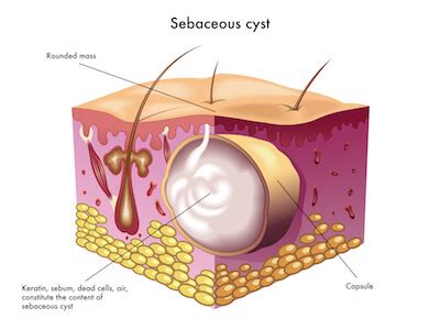 Sebaceous Cyst Removal Singapore | APAX Medical & Aesthetics Clinic