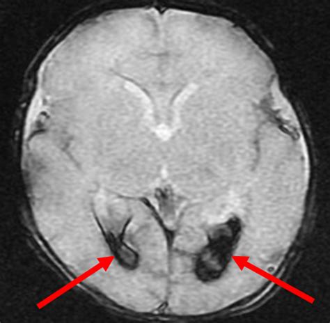 Germinal Matrix Hemorrhage Radiology