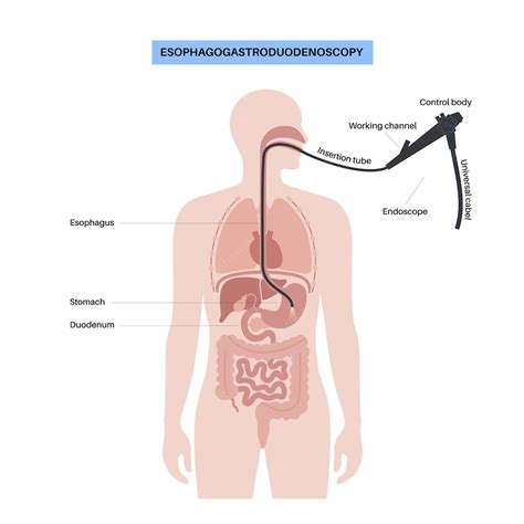 Premium Vector | Gastroscopy procedure Gastroenterologist uses a gastroscope Stomach and ...