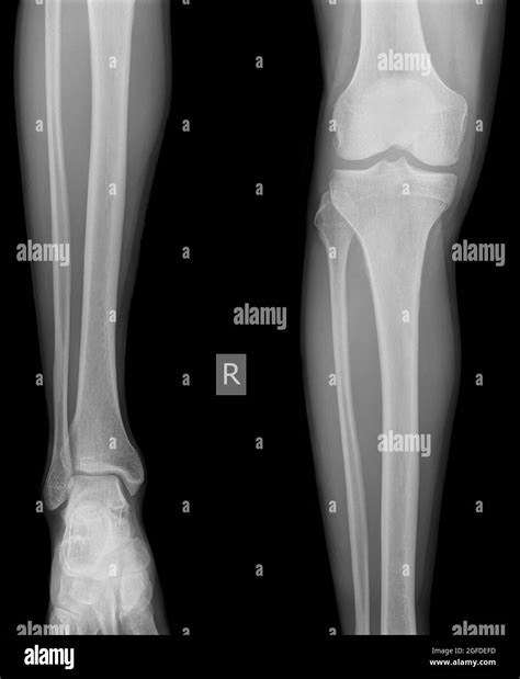 x-ray of the right knee of a 42 year old male no fracture or ...