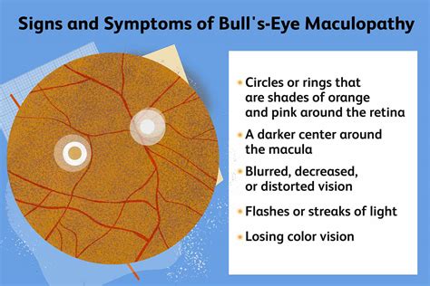 Bull's Eye Maculopathy: Signs, Causes, Diagnosis and More