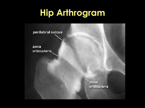 PPT - Application of Hip Arthroscopy PowerPoint Presentation, free ...