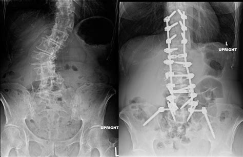 Degenerative Scoliosis of the Lumbar Spine | Spine Specialist | Vail ...