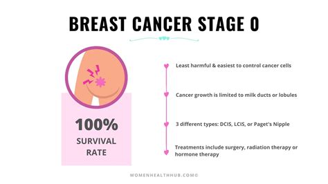 Everything About 5 Stages of Breast Cancer With Treatments