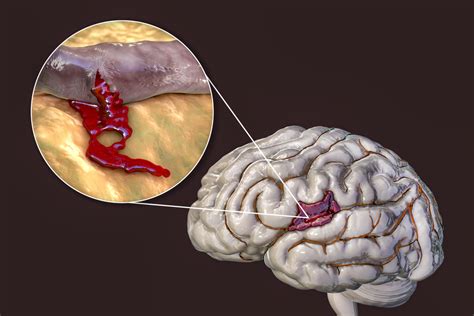 Understanding Brain Bleed and Hemorrhage Injury Cases in Personal ...