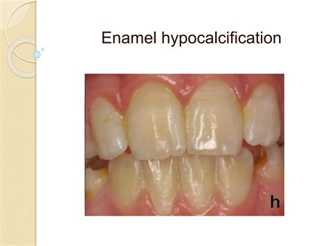 Amelogenesis (enamel formation) oral biology anf histology | PPT