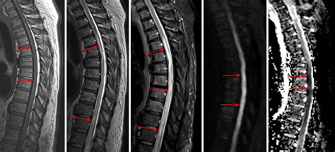 Spinal Cord Infarct | The Neurosurgical Atlas