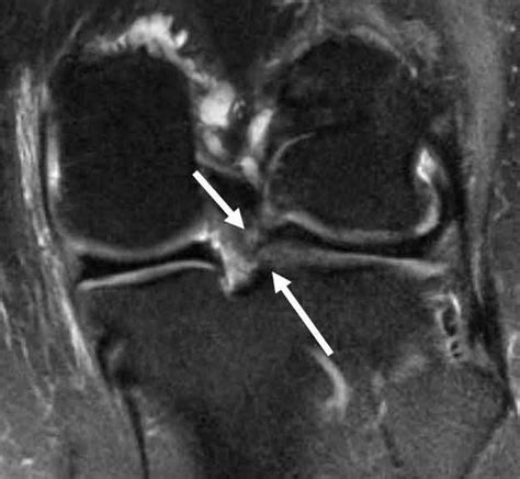 Medial Meniscus Tear Mri