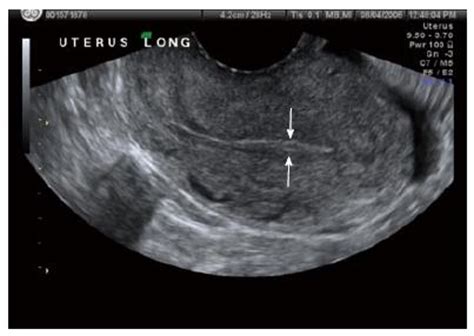 Does A Thick Uterine Lining Mean Pregnancy - PregnancyWalls