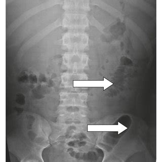 Sentinel loop sign and colon cut-off sign in a similar plain abdominal ...