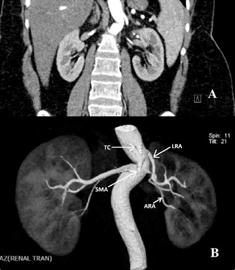 A. Coronal image of CT angiography; visualisation of tortuous aorta and... | Download Scientific ...