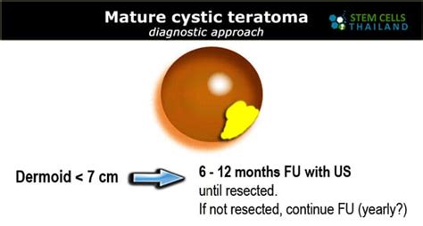 Teratoma Symptoms and Causes | Teratomas and Cancer