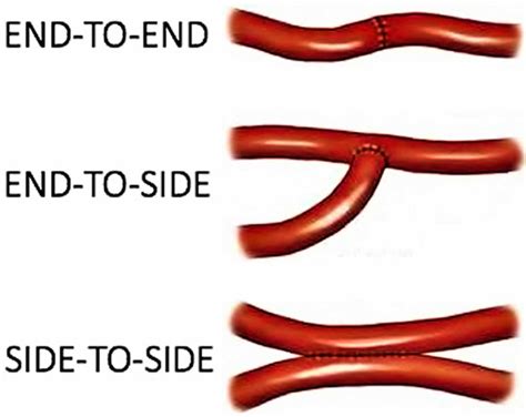 Anastomosis surgery, vascular anastomosis and bowel anastomosis