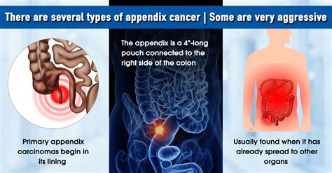 Stages Of Appendix Cancer