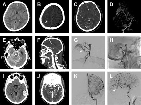 Cerebral Arteriovenous Shunts In Children Radiology K - vrogue.co