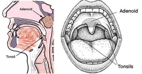 What Are Adenoids And Tonsils