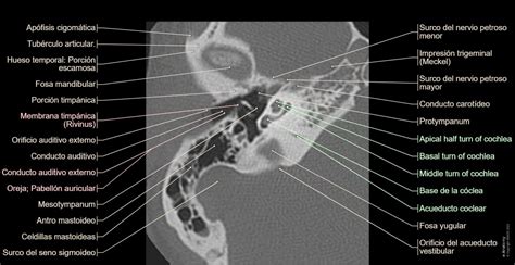 Hueso petroso TC : anatomía normal | e-Anatomy