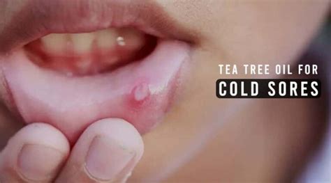 Tea Tree Oil for Cold Sores: How to Use & Dosage | HealthtoStyle