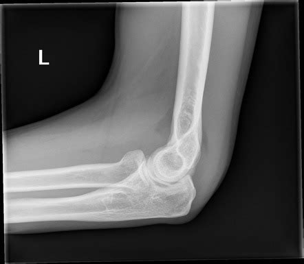 Posterior fat pad sign (elbow) | Radiology Reference Article ...