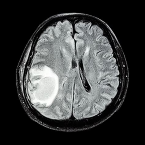 MRI brain : show brain tumor at right parietal lobe of cerebrum Stock Photo by ©stockdevil_666 ...