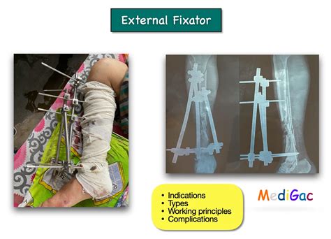 External fixation – Indications, Types, Working principle ...