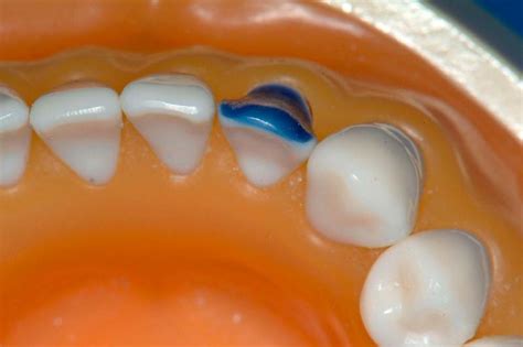 Mandibular Right Lateral Incisor (4.2 FDI, 26 Universal) - Labial and Incisal Veneer Preparation