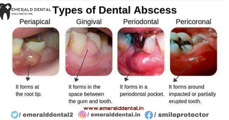 TYPES OF DENTAL ABSCESS - EMERALD DENTAL