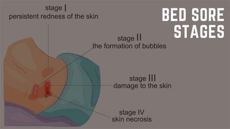 Bed Sores Causes, Stages & Treatment Plans - BA Lawyers