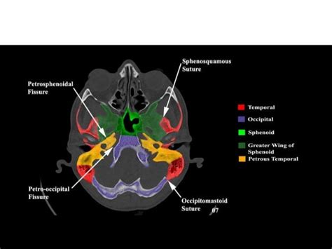 Greater And Lesser Wing Of Sphenoid Ct - slidesharetrick