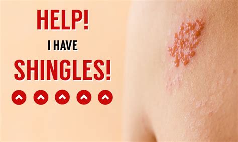 Help! I have Shingles! - U.S. Dermatology Partners