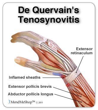 De Quervain's Syndrome | Hand therapy, Physical therapy, Massage therapy