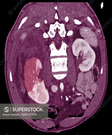 Renal infarct. Oblique axial Compted Tomography (CT) scan of the the ...