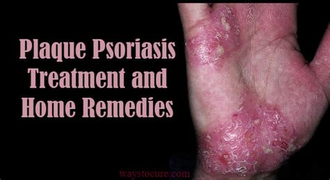 Plaque Psoriasis Treatment and Home Remedies - Ways to Cure