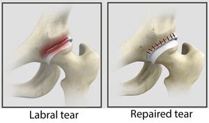 Hip Labral Repair - Florida Ortho Care